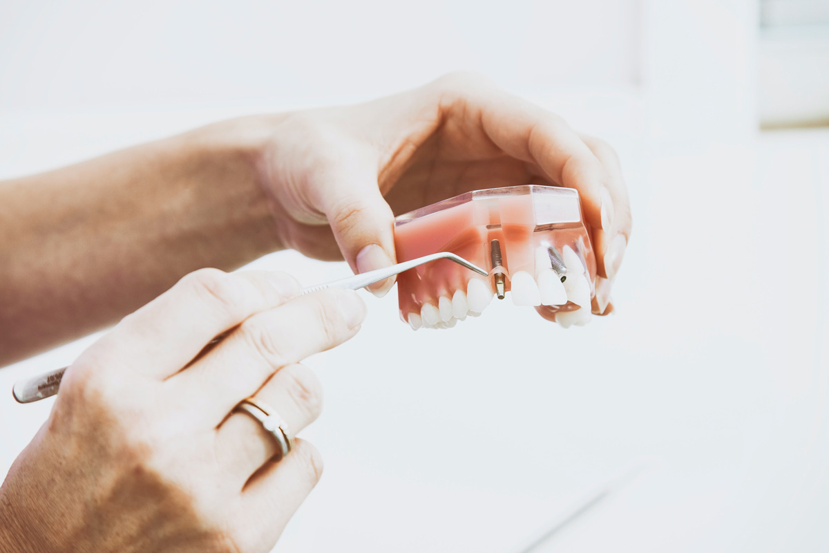 Dentadura falsa con implantes dentales