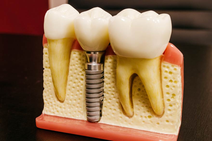 implante dental de titanio