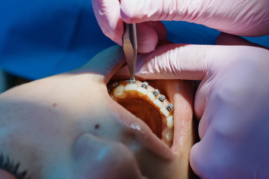 Dentista poniendo brackets