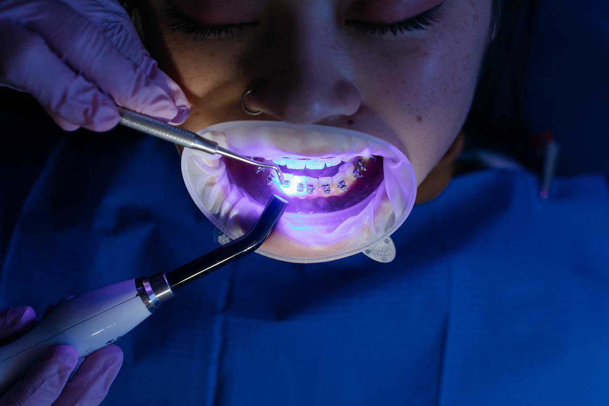 Dentista poniendo brackets